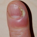 Воспаление заусенца на пальце лечение в домашних
