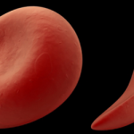 Серповидная анемия это наследственное заболевание или нет