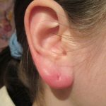 Что делать когда гноятся и болят проколы в ушах