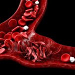 Серповидная анемия это наследственное заболевание или нет