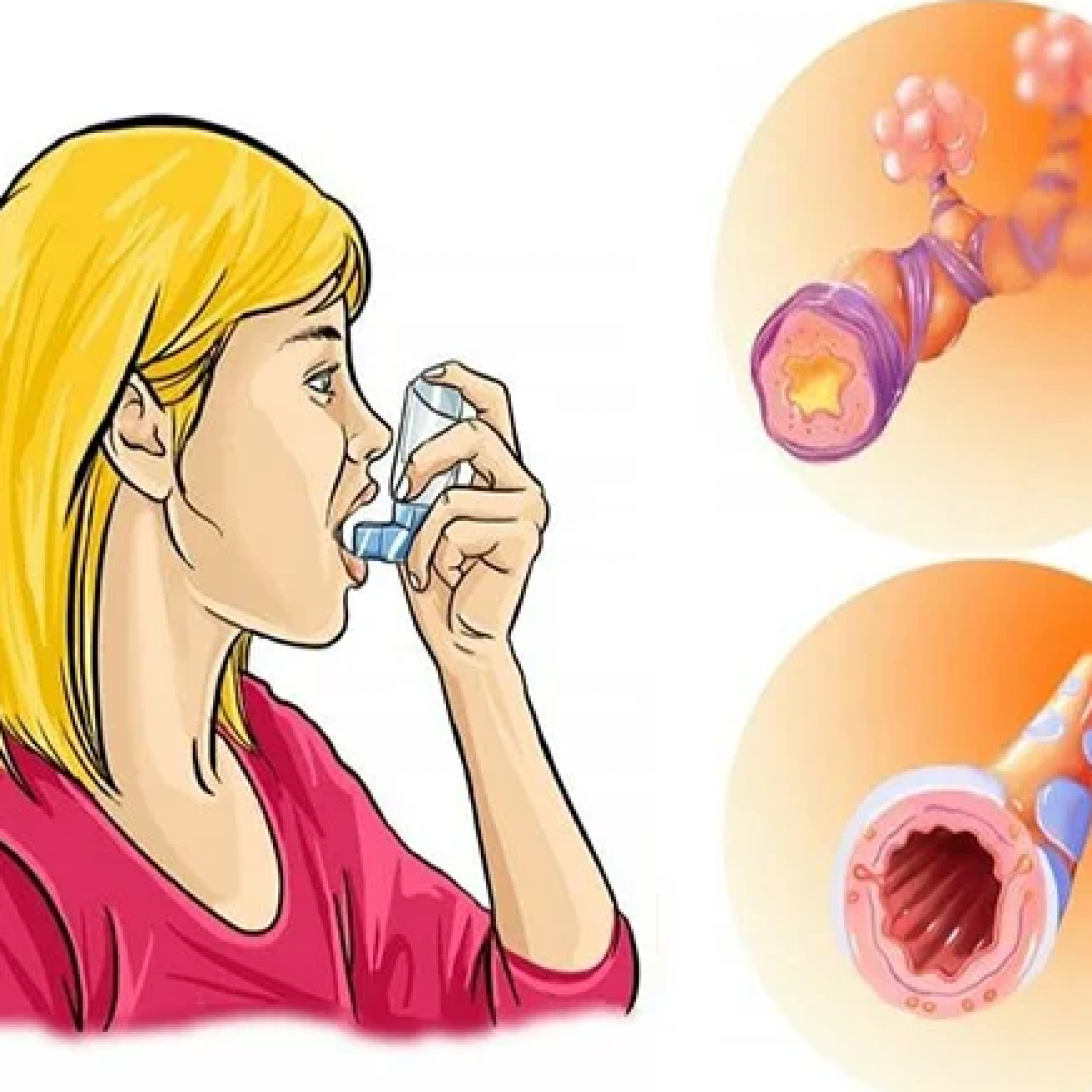 Аллергический кашель с мокротой