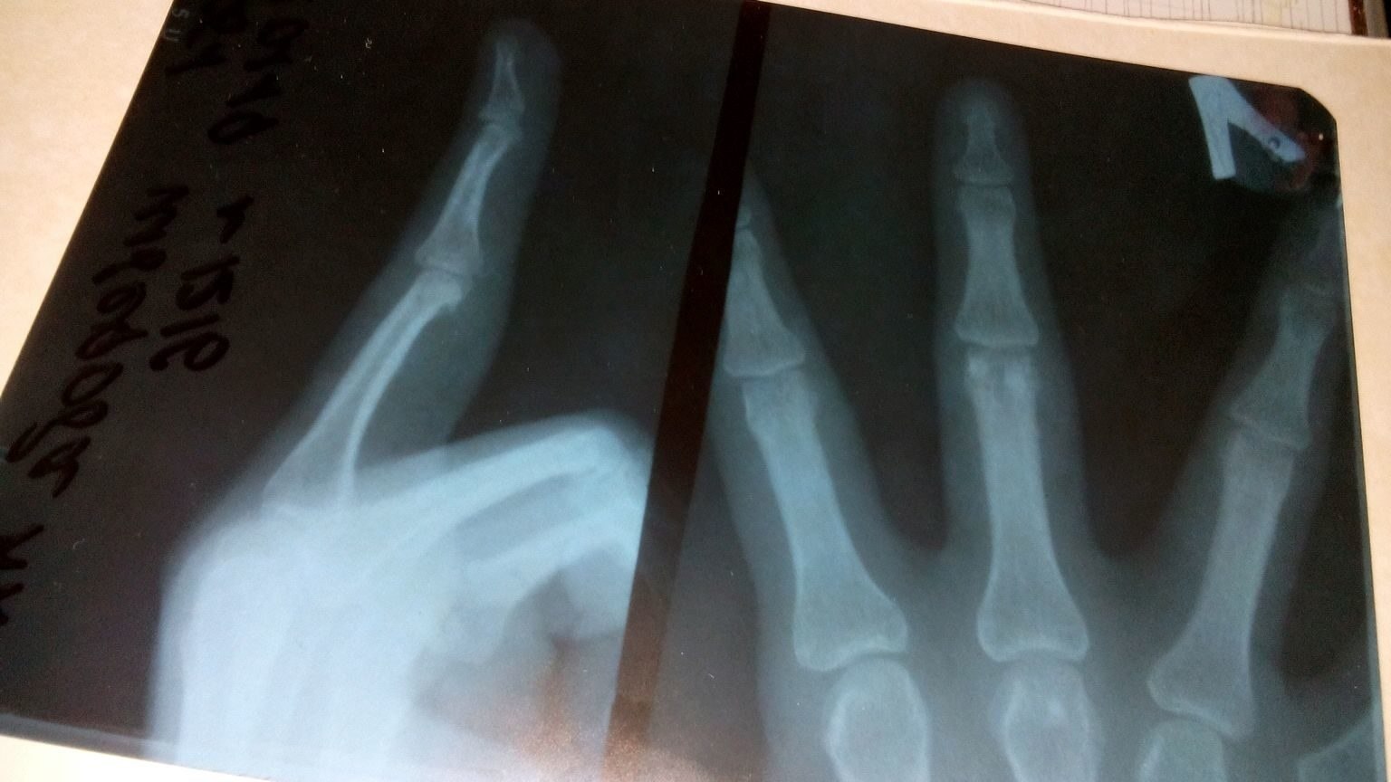 Трещина срослась. Снимок сломанной руки рентген. Перелом третьей степени.